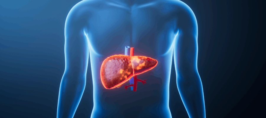 Ilustração anatômica do corpo humano (em azul) destacando o fígado em tom alaranjado, representando uma alteração no fígado.